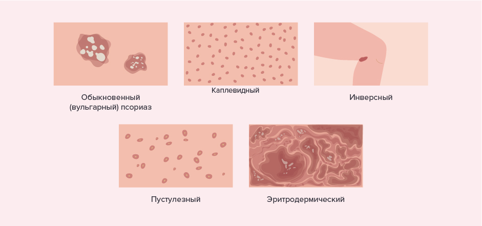Псориаз лечение - чем лечить псориаз на теле? Диагностика и лечение псориаза в Москве.